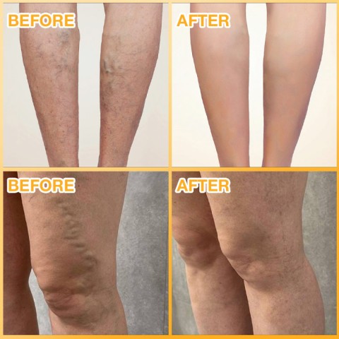 Turmeric Varicose Vein Patch